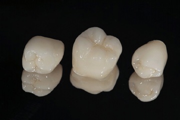 dental crowns in Naples