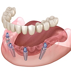 Illustration of a full denture in Naples, FL being attached to dental implants