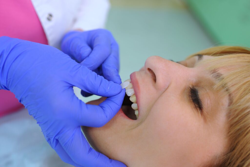 Dentist in blue gloves placing veneers on woman's teeth